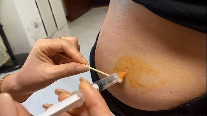 试管婴儿移植前打针