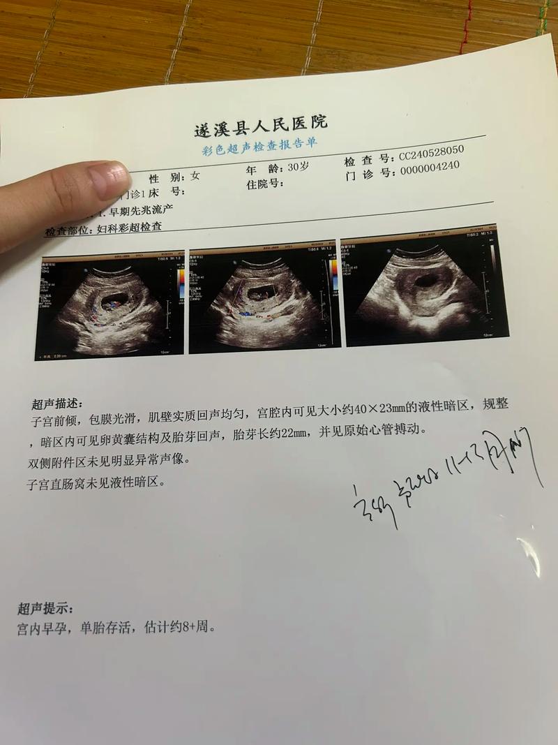 怀孕检测胎心