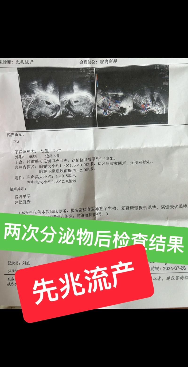  流产前兆