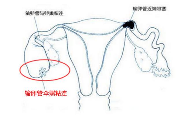输卵管细胞治疗