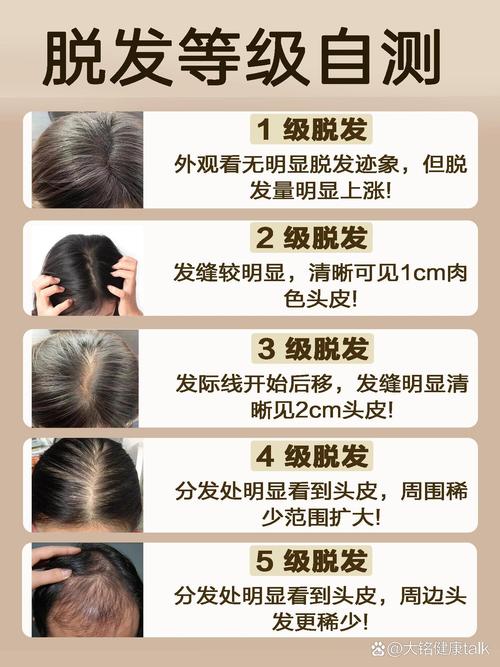 脱发程度