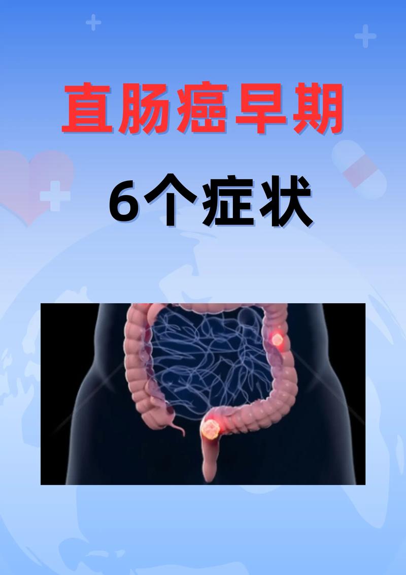 肠癌