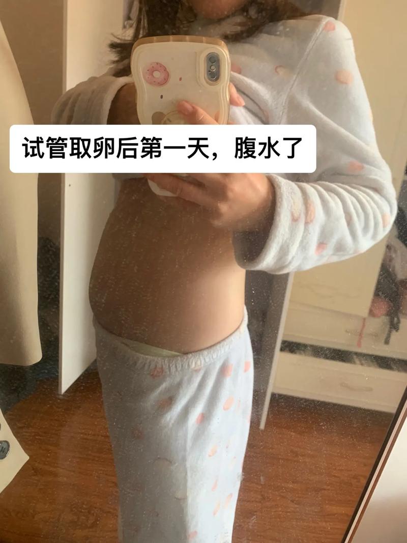 试管婴儿、移植后腹水、生殖医学