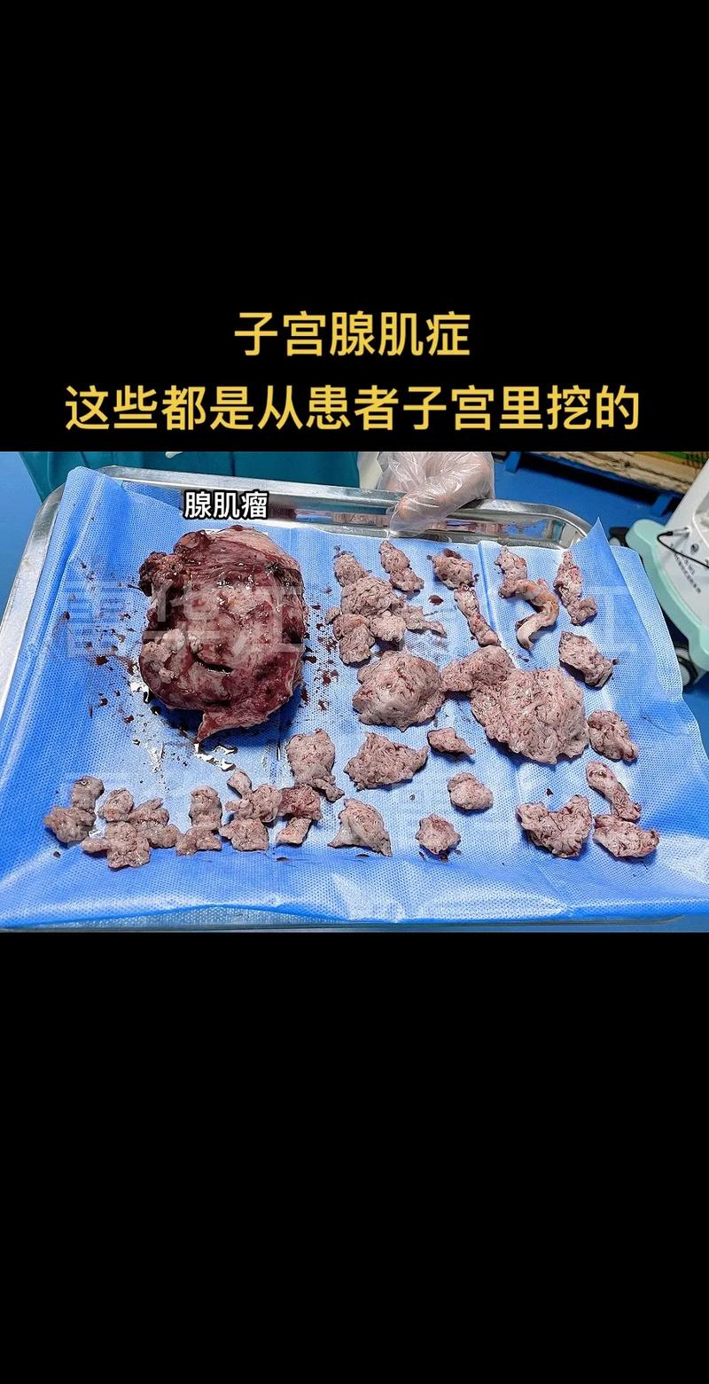 腺肌症手术