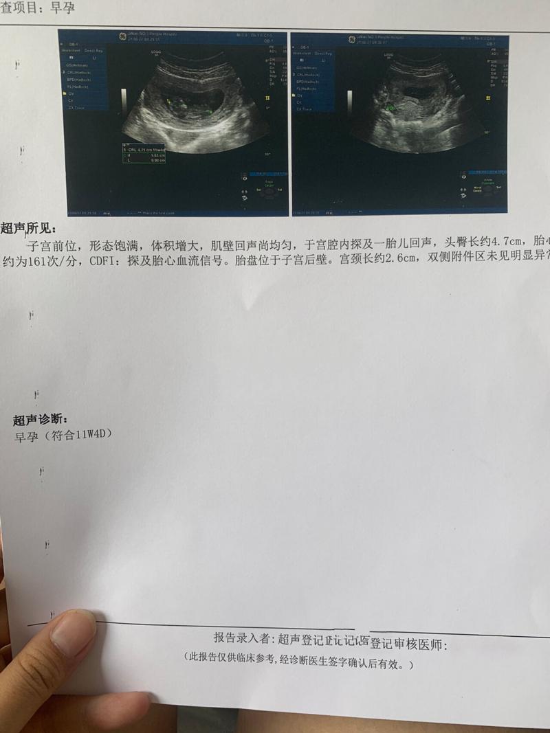  胎停几率