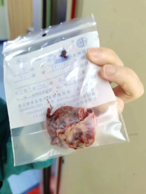 巧囊剥除手术