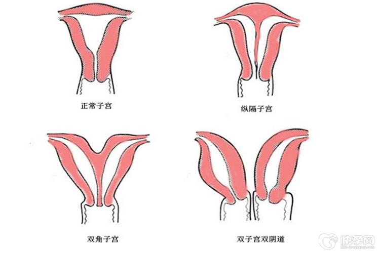  子宫畸形