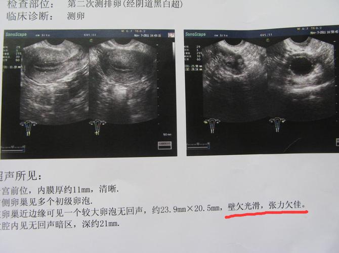 卵子募集