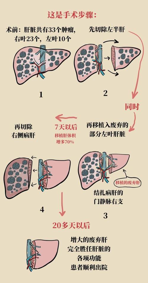 肝移植