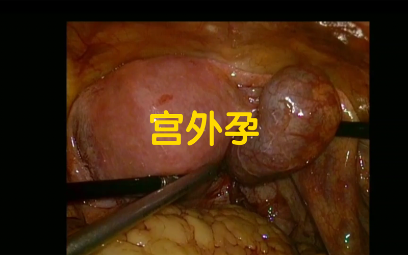 输卵管全切