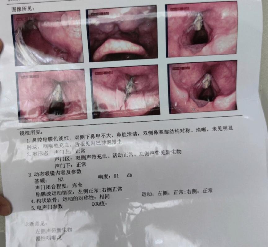 喉癌