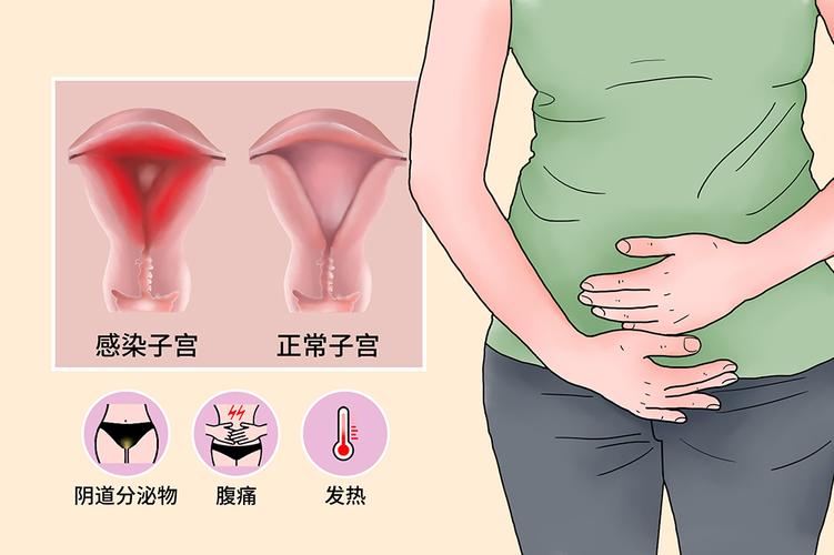 宫腔感染
