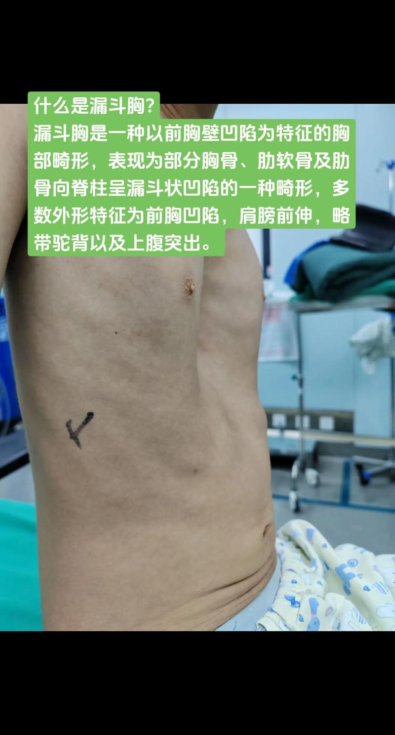 漏斗胸