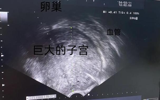 腹部B超