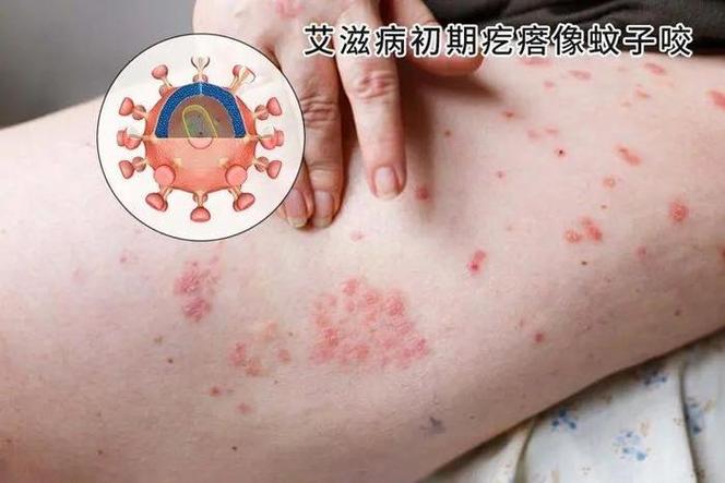  HIV感染者