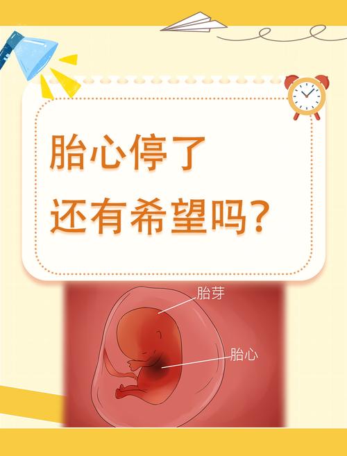 胎心停