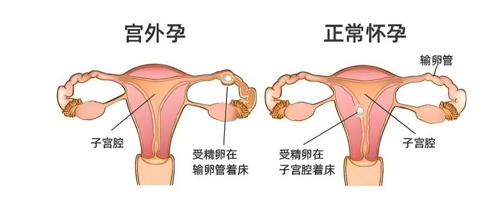 宫内孕