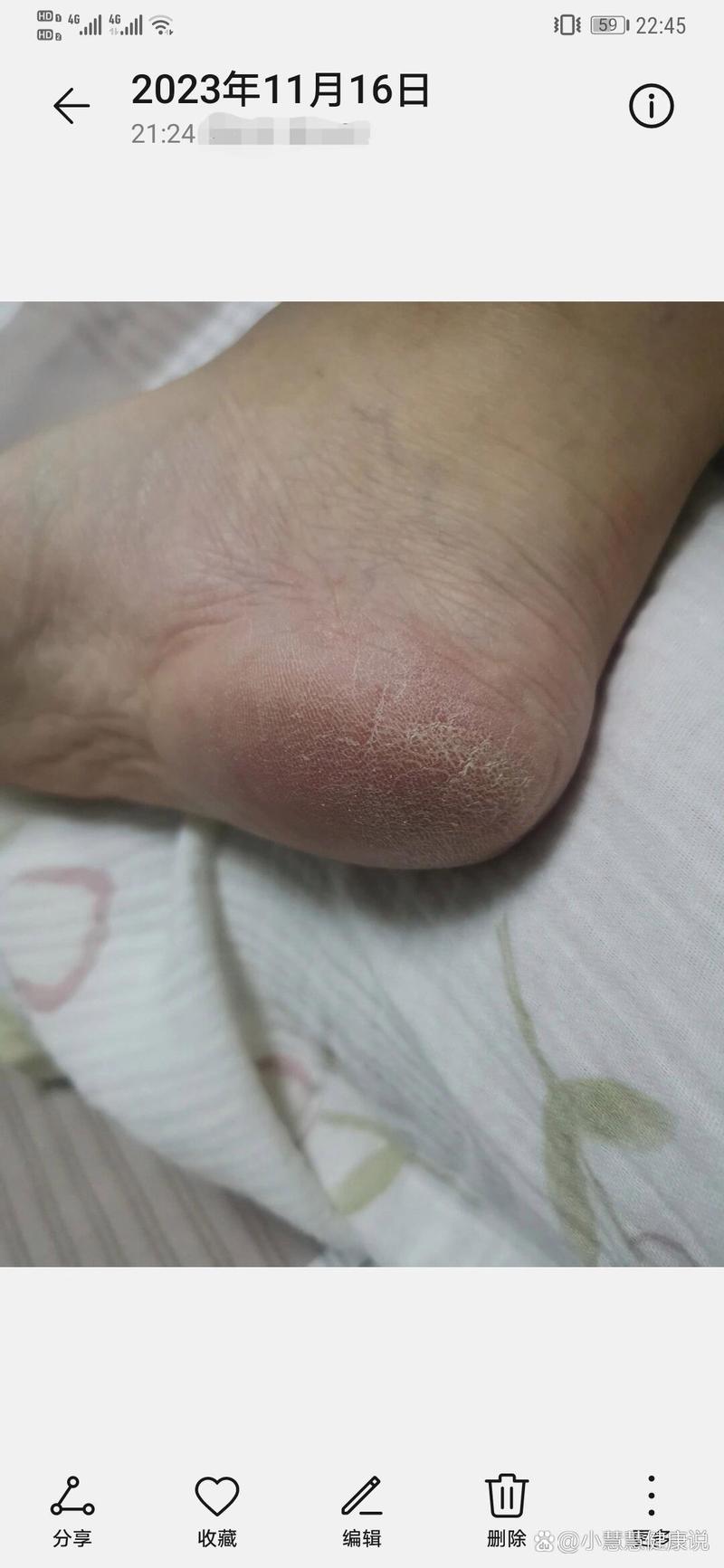 脚后跟粗糙