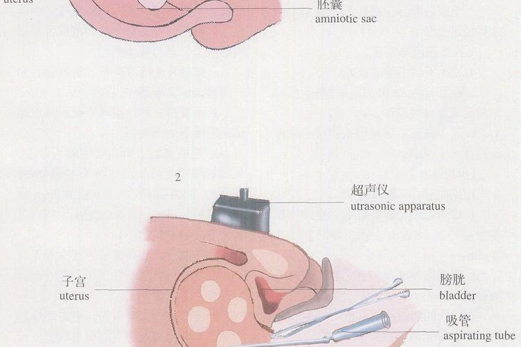  胚胎减胎术