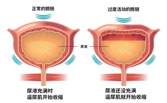 膀胱内膜异位症