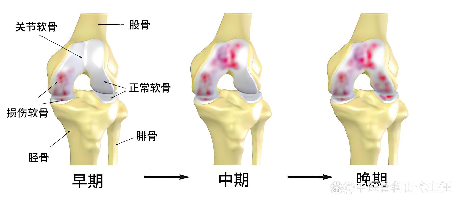 骨关节炎