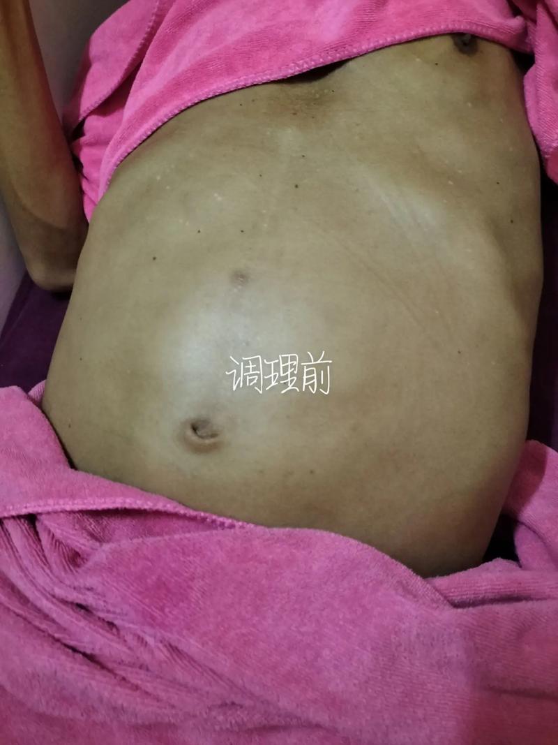 腹部积水
