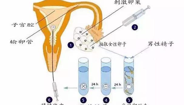 试管婴儿手术方式