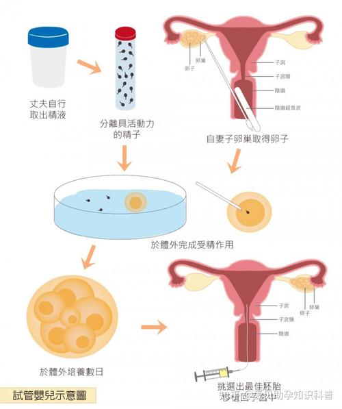 试管婴儿二代、不授精、辅助生殖、生育技术