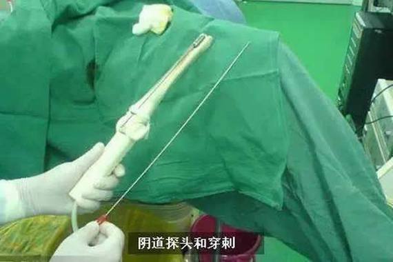卵子取出次数