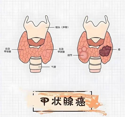 甲状腺