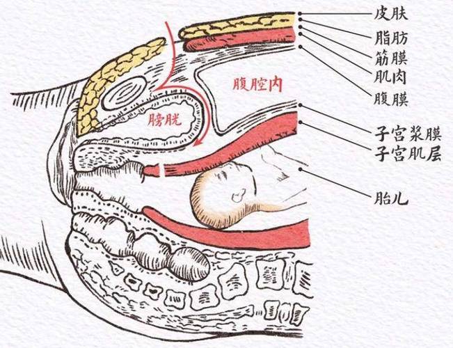 腹膜外剖宫产