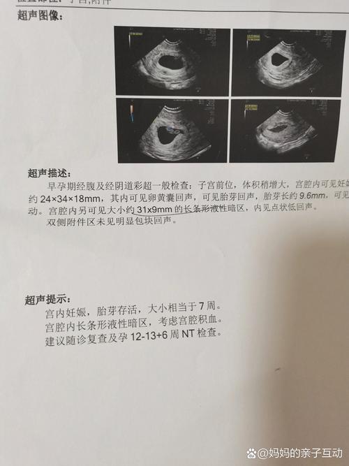 宫腔积血