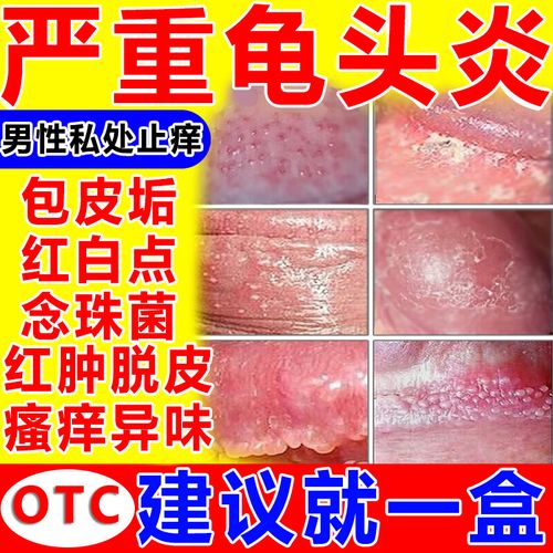 念珠菌性龟头炎