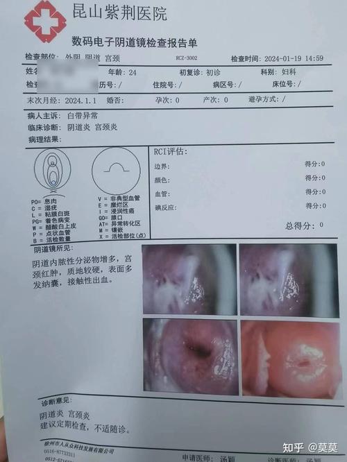 宫颈炎症