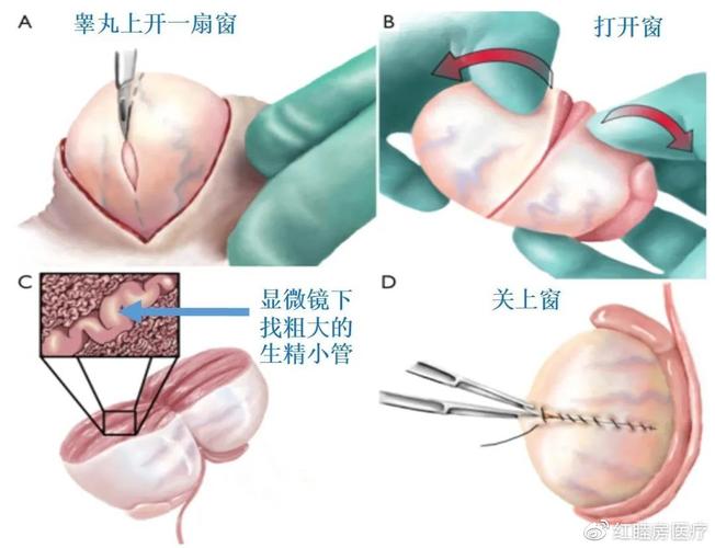 显微取精技术