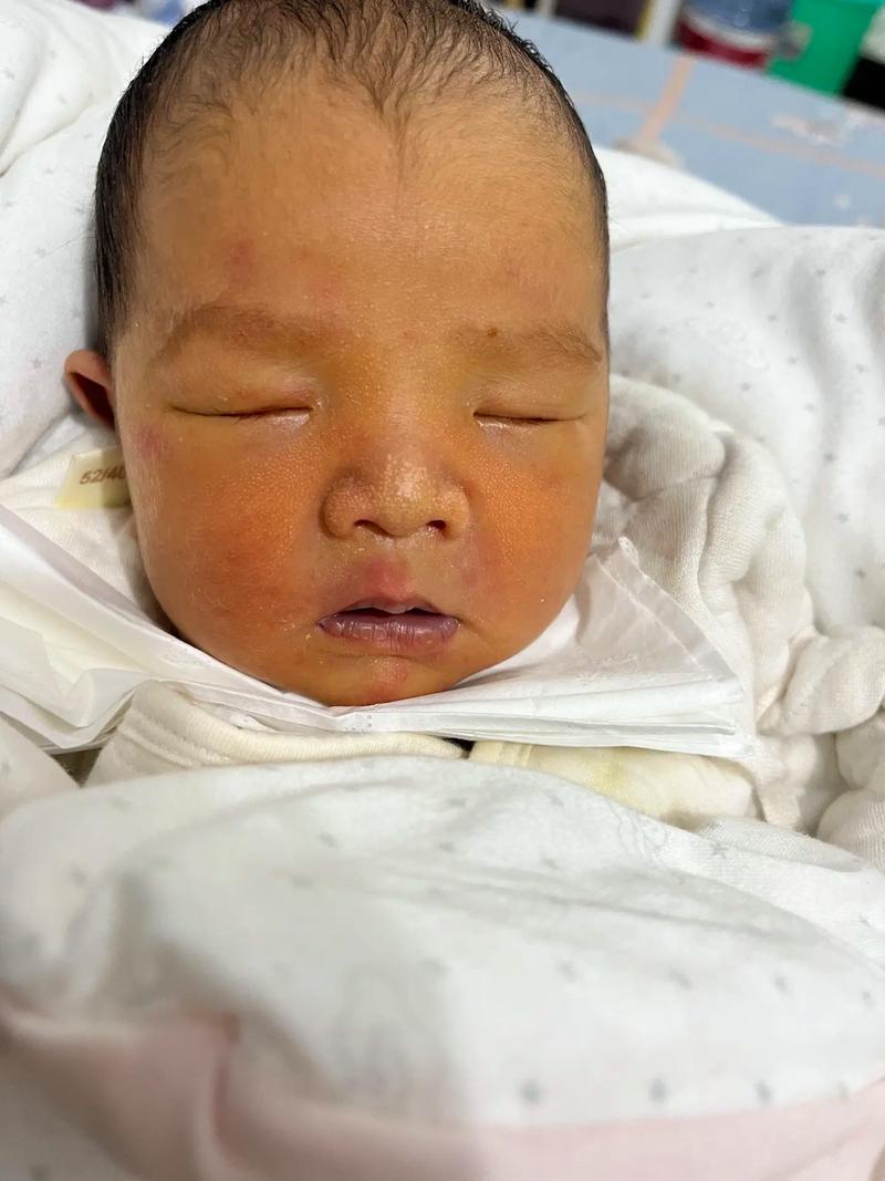 新生儿黄疸