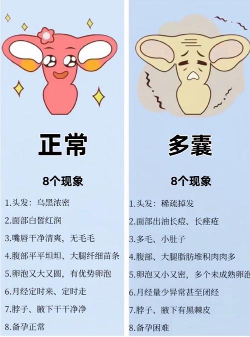  多囊卵巢综合症