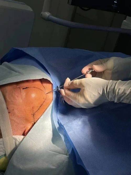 TESE手术