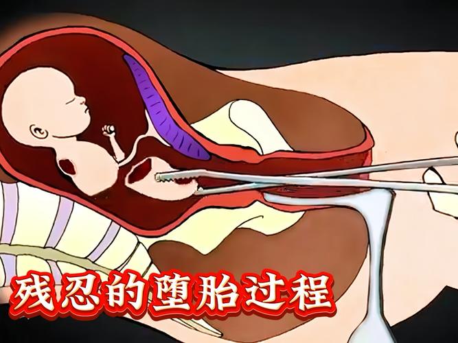 孕期流产