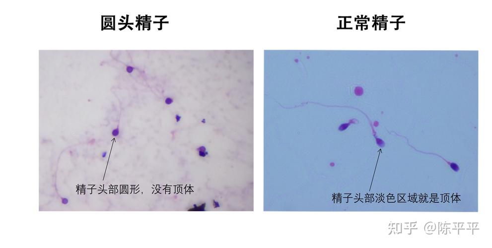 圆头精子
