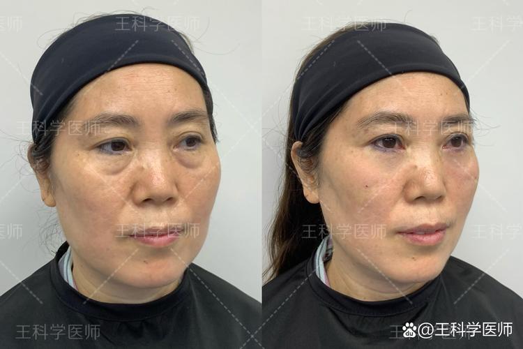 手术效果