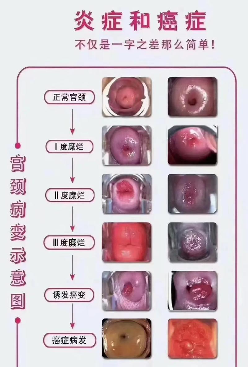 宫颈判断