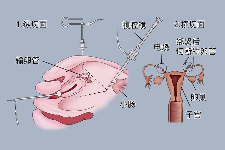 女性结扎