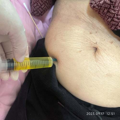 腹水处理