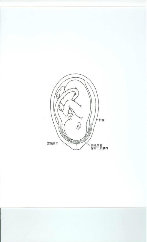 胎盘剥离