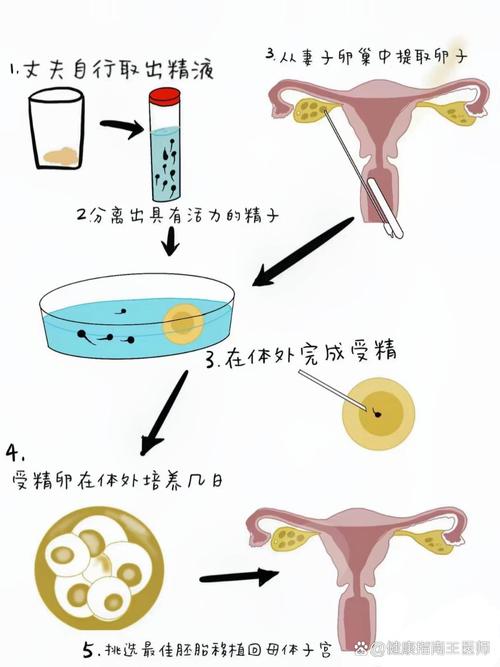 试管留精技术