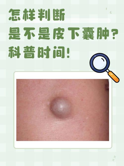 囊肿大小