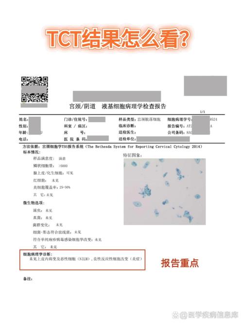 TCT筛查