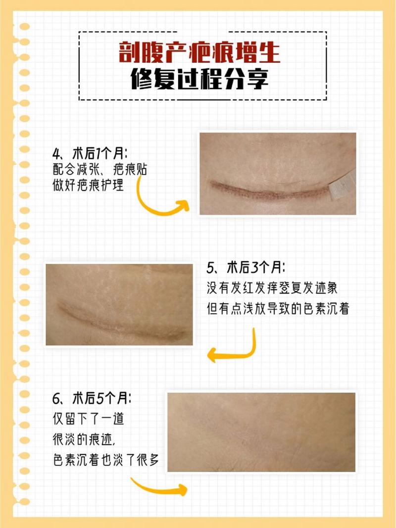 剖腹产恢复