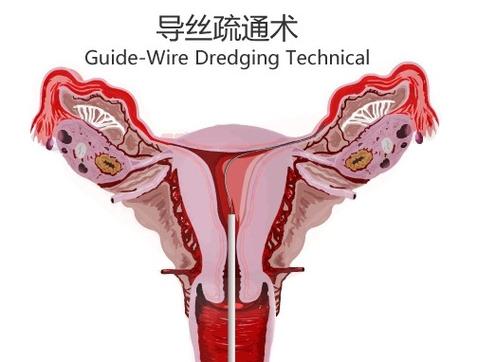 输卵管处理